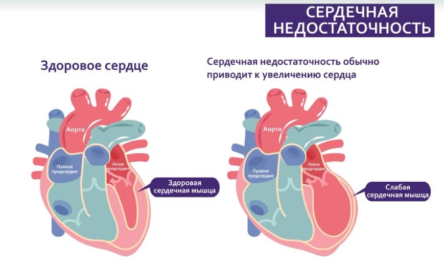 Сердечная недостаточность