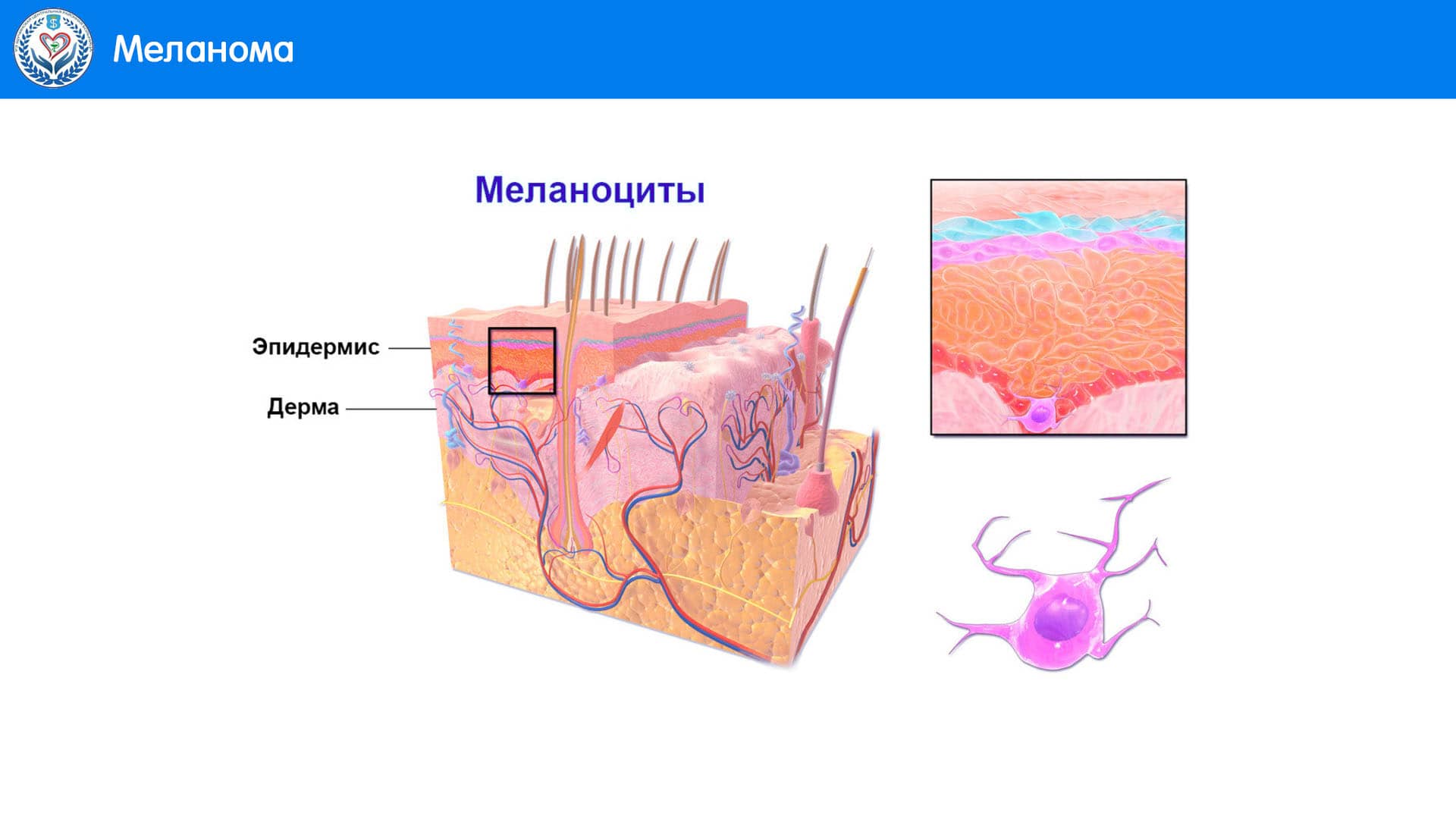 МЕЛАНОМА-ФОКУС