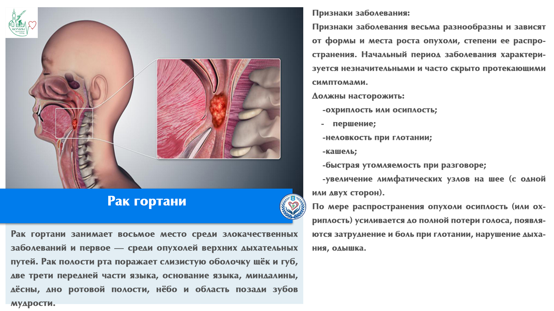 Рак гортани