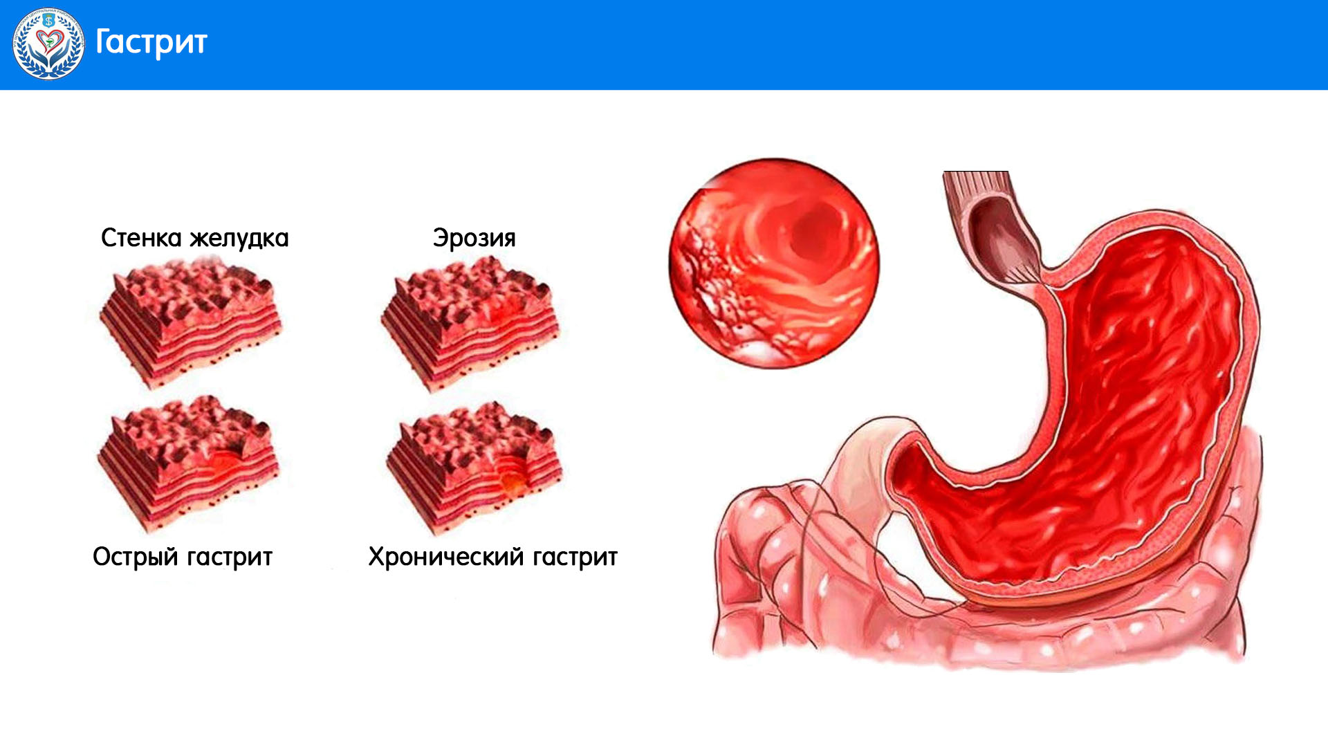 Хронический гастрит