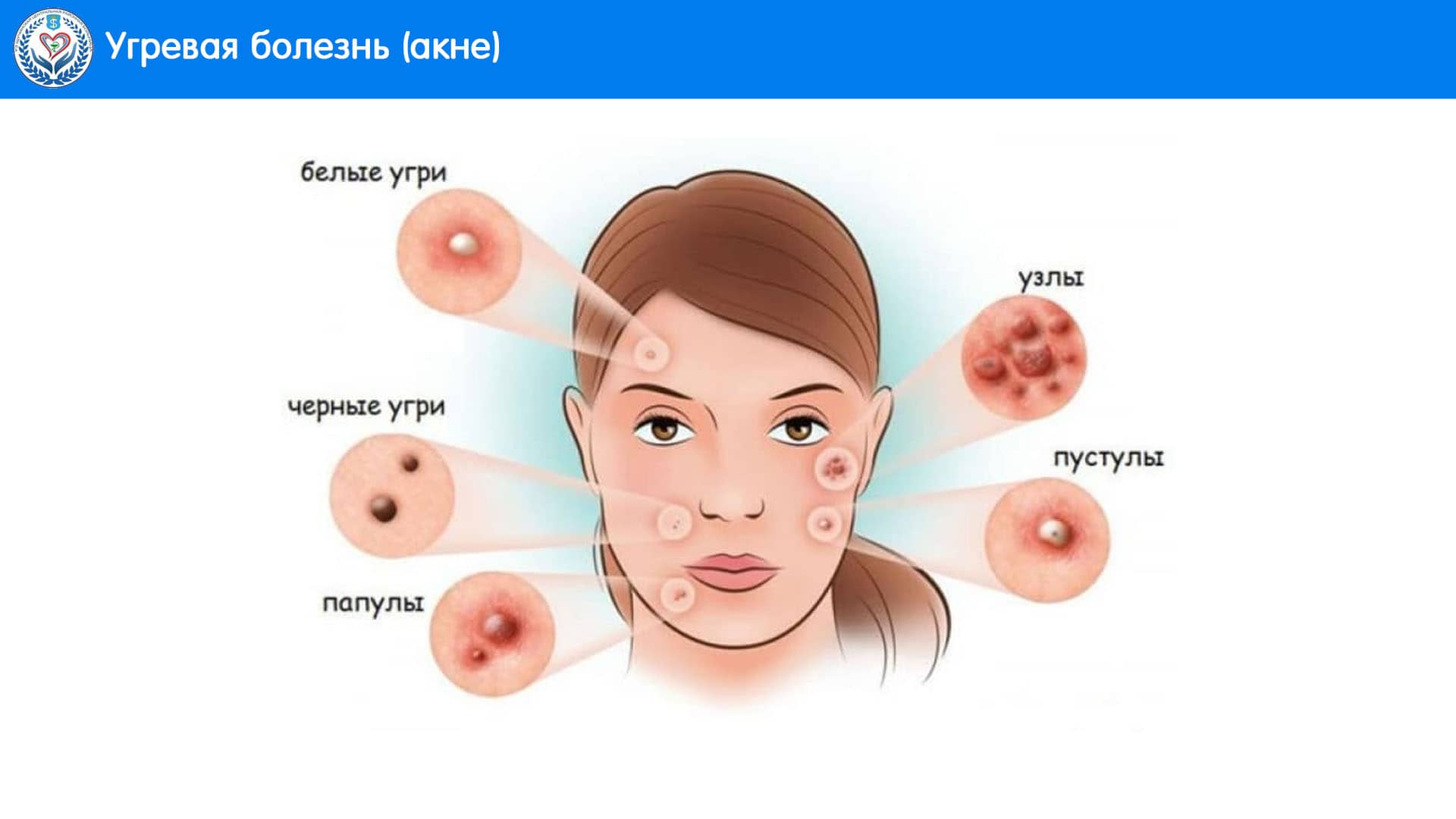 Угревая болезнь (акне)